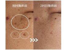 ソイ(Soi)/変化が一目瞭然！