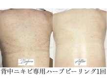 ビズビズ 梅田店(bisebise)/〈症例〉背中ニキビケア・赤み跡