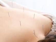 ヘルシースリムウエダ/施術風景【ひばりが丘/鍼灸】