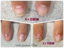ウイ(Oui)/自爪育成、トラブルネイル