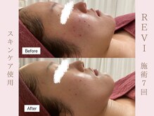 ルア(LuA.)/敏感肌でも施術可能◎