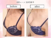 リール 恵比寿店(RIRE)/バストアップ症例【広尾恵比寿】