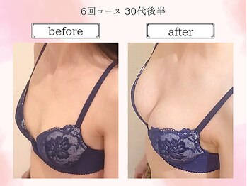 リール 恵比寿店(RIRE)/バストアップ症例【広尾恵比寿】