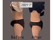 ウナ 福岡店(UNA)/モニター様★ぽっこりお腹　2cup