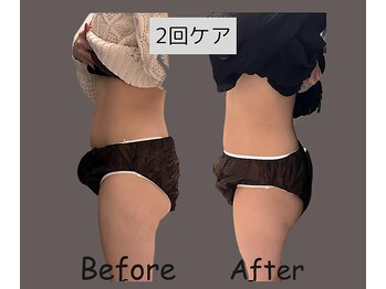 ウナ 福岡店(UNA)/モニター様★ぽっこりお腹　2cup