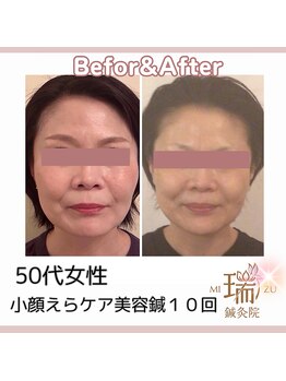 瑞 鍼灸院/ビフォーアフター美容鍼10回