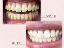 ルアナシンフォニア エクシア 池袋店(Luana-Sinfonia)/ホワイトニングビフォーアフター