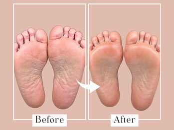 ベベ(Bebe)/40代女性/タコお悩み