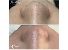 ジュエカフネ 広尾(JueCAFUNe)/ポツポツ毛穴、サヨウナラ！