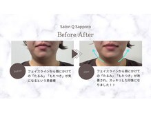 キューサッポロ(SalonQSapporo)/たるみに美容鍼ビフォーアフター