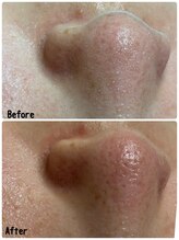 ブロッサム(Blossom)/オプション毛穴掃除Before After