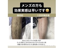 アイルハイパースキンの雰囲気（メンズの方も全身OK）