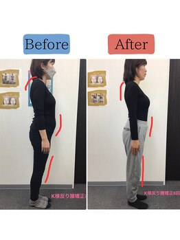 ステイゴールド美容整体院(STAY GOLD)/美容姿勢矯正の効果（反り腰）