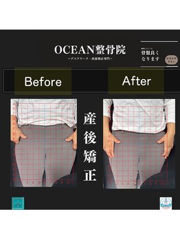 オーシャン整骨院(OCEAN整骨院)/産後矯正の骨盤ビフォーアフター