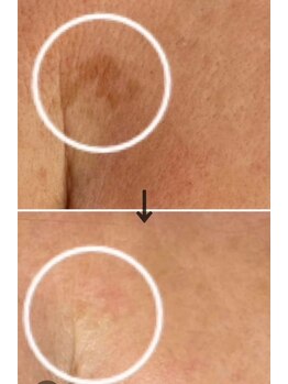 ラエッセ 恵比寿(LAESSE)/毛穴・美白専門店 LAESSE 恵比寿