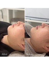 ラ フルール(La Fleur)/エアバリフェイシャル