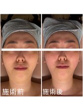 ビューティースタジオ ハンミ 福岡大名店(Beauty studio 韓美)/小顔コルギ