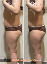 アシュレ リル 西多賀店(assure Lilou)/マシン、ハンドで脂肪を速攻撃退