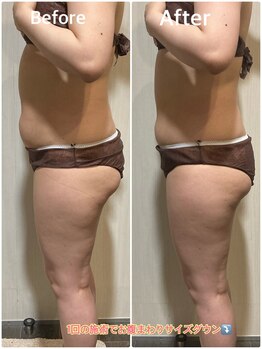 アシュレ リル 西多賀店(assure Lilou)/マシン、ハンドで脂肪を速攻撃退