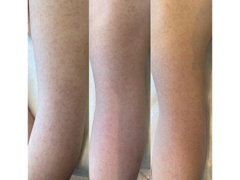 リベル 名古屋(Lebelle:)/ハーブピーリング 名古屋