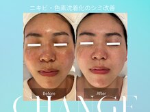 マインエム(mine.m)の雰囲気(577万本!肌の奥まで届けるハーブピーリングで肌の奥から肌改善)