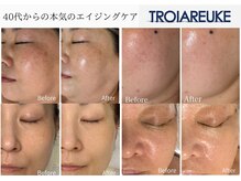 【VVSダイヤモンドピーリング】1度で劇的変化！