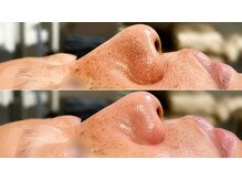 アナハタビューティーサロン(aNahata beauty salon)の雰囲気（#毛穴#黒ずみ#いちご鼻）