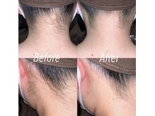 キュアバイアニーアンドジーノ(Qa by Annie&Gino)/脱毛♪