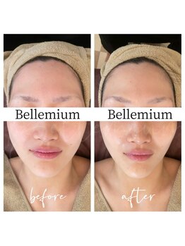 ベレミアム(Bellemium)/小顔効果、肌質改善