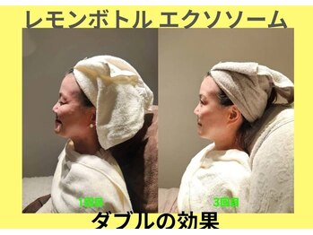 アン 銀座(ann)/レモン&エクソWの効果