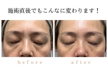 ココカラ(COCOKARA)/1度の施術で5歳若見え!