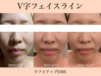 ラーナ(Lana)/リフトアップEMS　BIFORE→AFTER