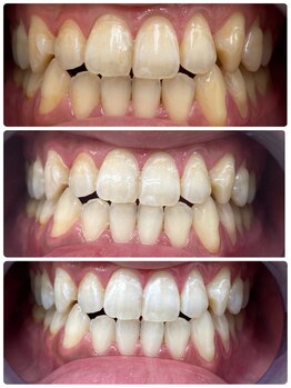 コナホワイトニング 神保町/3ヶ月ホワイトニング