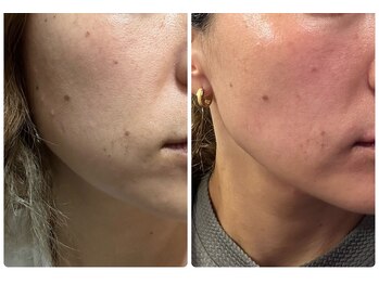 プリューム(Plume)/本気のシミケア！