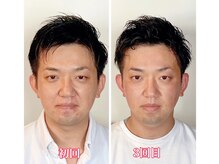 小顔22 ボルティ 本店(Bolty)/Before→After（3回目）むくみ