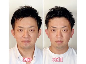 小顔22 ボルティ 本店(Bolty)/Before→After(3回目)むくみ