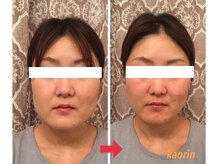 顔凛(カオリン)/30代女性の小顔矯正