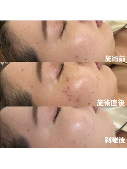 TD 一宮店/★シミケア★ 30分