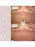 【たるみ/小ジワ/ほうれい線改善】サーマルフラクショナルFACIAL（40分）