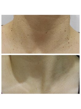 ザ シー タイムレスビューティ(THE SHE)/50代お客様症例写真