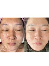 マヴィー(MAVIE)/リベルハーブピーリング