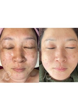 マヴィー(MAVIE)/リベルハーブピーリング