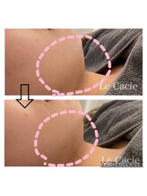 ルカシエ(Le Cacie)/20代女性/脂肪分解液導入