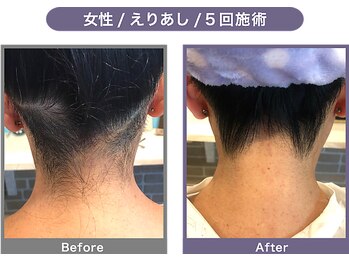 アンフィー 川西能勢口店(Une f`ee)/うなじ脱毛のBefore,After★