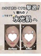 ビレボ マエバシ(BEREVO maebashi)/Before　After