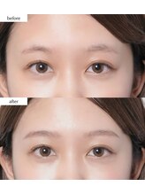 ラキ(LAKI)/HBL ビフォーアフター