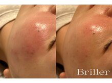 ブリエ(Briller)/ハーブピーリング