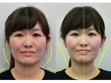 宮崎整体院/【小顔矯正・顔の歪み矯正】