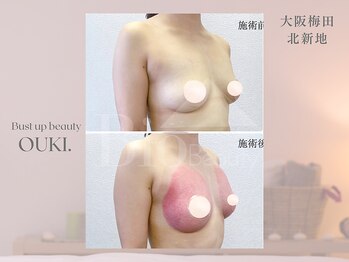 【育乳・バスト専門×女性らしさを磨く】OUKI. 梅田北新地【3月1日 OPEN（予定）】/バストアップ結果写真