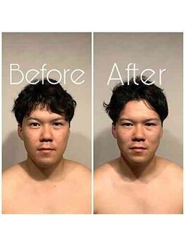 グレースフィオーレ 町田店(gracefiore)/ビフォーアフター/施術1回の効果